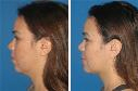 Before & After Photos